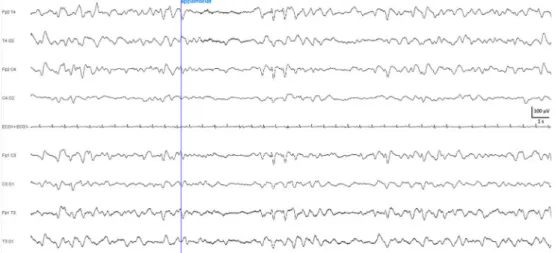 Fig. 6 Encéphalopathie hépatique caractérisée par la présence de trains diffus d ’ ondes triphasiques transitoirement bloquées par la stimu- stimu-lation