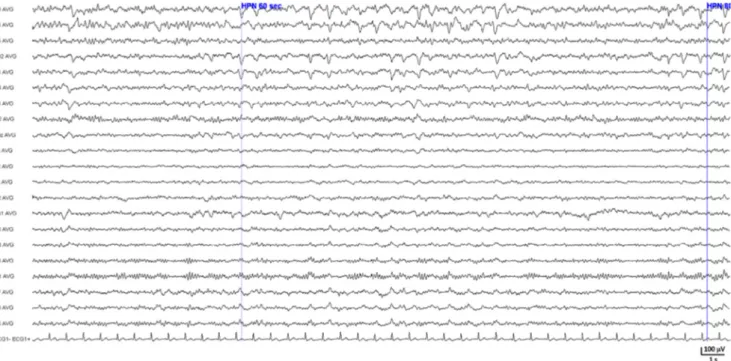Fig. 9 Oligodendrogliome frontal droit s ’ exprimant sur l ’ EEG par un foyer lent delta polymorphe frontal droit mêlé d ’ irrégularités lentes pointues diffusant en temporal antérieur droit et en frontal gauche