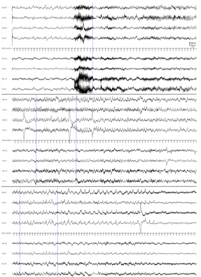 Fig. 10 Crise épileptique frontotemporale droite (trois segments successifs de 30 secondes) sur hémorragie cérébrale frontale droite s ’ exprimant par une activité rythmique se ralentissant progressivement
