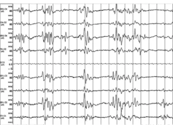 Fig. 11 Tracé de supression burst à j2 d ’ un arrêt cardiorespira- cardiorespira-toire, témoignant d ’ une encéphalopathie postanoxique sévère.