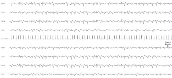 Fig. 13 Encéphalopathie hépatique s ’ exprimant par des ondes triphasiques diffuses à prédominance antérieure, se répétant de manière pseudorythmique