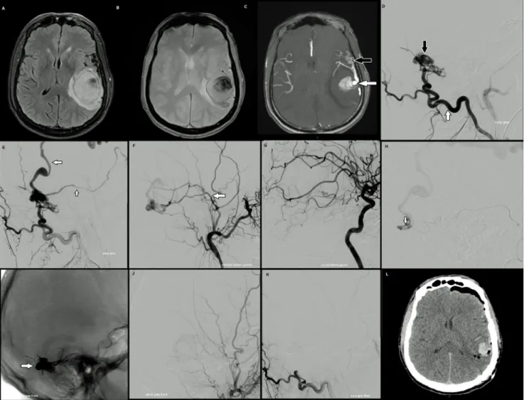 Fig. 2 Hématome lobaire secondaire à une fistule durale intracrânienne IV. A-B-C : IRM cérébrale en coupes axiales en séquences FLAIR (A) et T2* (B) montrant l ’ hématome lobaire pariétal gauche avec effet de masse sur les ventricules latéraux