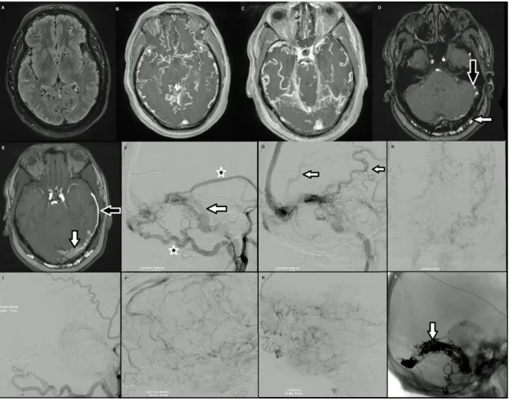 Fig. 3 Fistule durale de type VI avec coma Glasgow 6. A à E : IRM cérébrale montrant l ’ absence de franche anomalie du parenchyme cérébral (A), la dilatation majeure des veines cérébrales (B, C), la dilatation des artères méningées (D, flèche blanche) et 