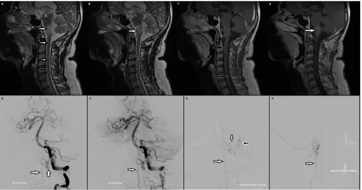 Fig. 4 Fistule durale de type V révélée par une tétraparésie et une atteinte bulbaire