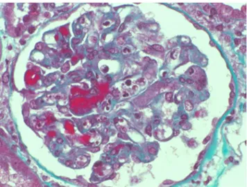 Fig. 1 Lésion histologique de microangiopathie thrombotique glo- glo-mérulaire (photo Dr M Rabant)