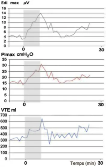 Fig. 3 Courbes de l ’ activité électrique diaphragmatique (EAdi), de la pression dans les voies respiratoires (Pimax) et du volume  cou-rant (V T ) en fonction du temps