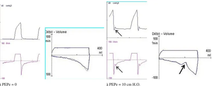 Fig. 1 Courbes pression/temps et débit/temps et boucles débit/volume chez un patient présentant un SDRA