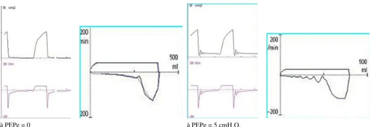 Fig. 2 Courbes pression/temps et débit/temps et boucles débit/volume chez un patient présentant une limitation de flux