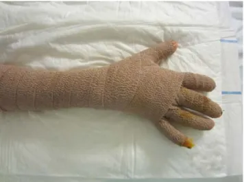 Fig. 4 Bandage cohésif à visée compressive au niveau de la main et des doigts