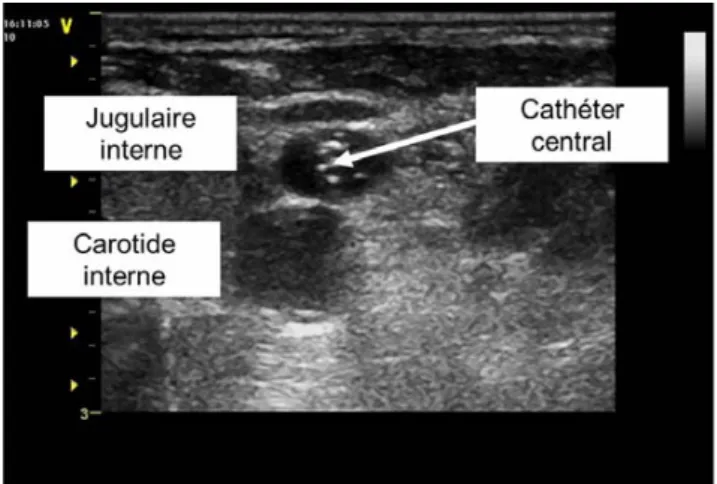 Fig. 2 Thrombose de la jugulaire interne, la veine est incompressible