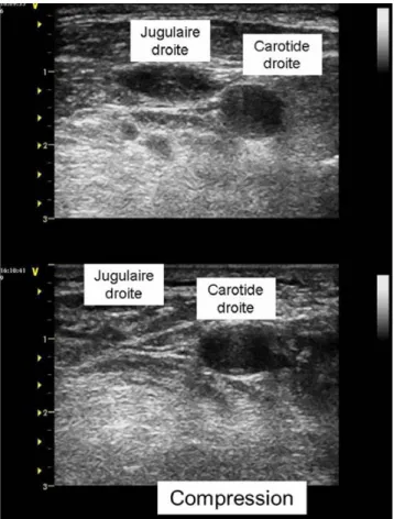 Fig. 3 Compression de la jugulaire interne droite effacement complet