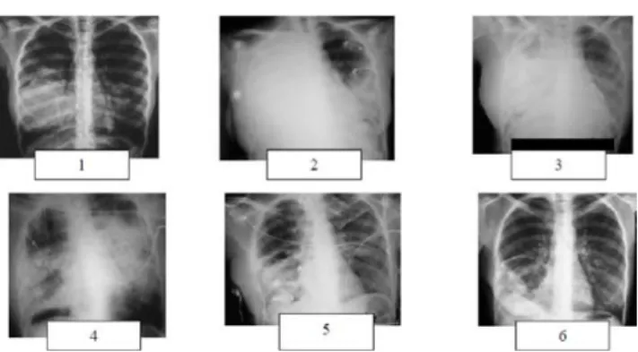 Fig. 8 Aspects radiologiques d ’ une pneumonie nécrosante d ’ évo- évo-lution foudroyante (clichés 1 et 2) traitée par drainage médical  (cli-ché 3) puis thoracotomie antérieure en urgence, nécrosectomie, drainage (cliché 4) puis spéléostomie, nécrosectomi