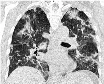 Fig. 5 Patient de 43 ans suivi pour adénocarcinome ganglionnaire abdominal sans primitif connu ; apparition d ’ une pneumopathie hypoxémiante 48 heures après le début de la première cure de  chi-miothérapie par gemcitabine et cisplatine