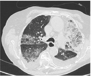 Fig. 6 Patiente âgée de 85 ans présentant une pneumopathie aiguë à l ’ amiodarone. Aspect de verre dépoli et condensation alvéolaire.