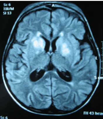 Fig. 3 Coupe axiale : flair d ’ un enfant de cinq ans présentant une épilepsie réfractaire avec des troubles du comportement au décours d ’ une infection à EBV ayant révélé un syndrome  lym-phoprolifératif lié à l ’ X montrant des lésions en hypersignal  t