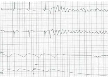 Fig. 5 Fibrillation ventriculaire. Le tracé ECG anarchique s ’ ac- ac-compagne d ’ une inefficacité circulatoire dont attestent les courbes