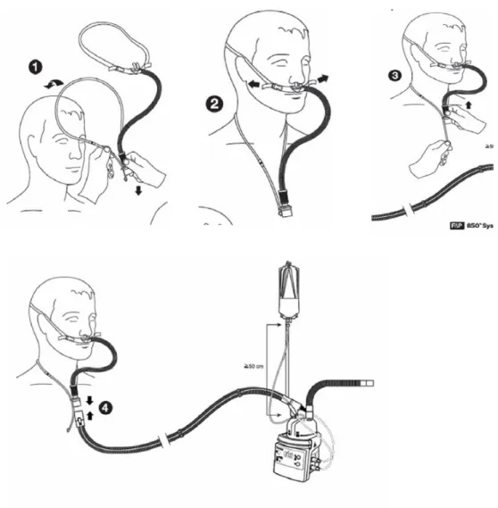 Fig. 2 Mise en place des canules nasales