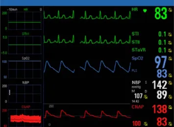 Fig. 4 Monitorage continu de la pression artérielle non invasive (CNAP)