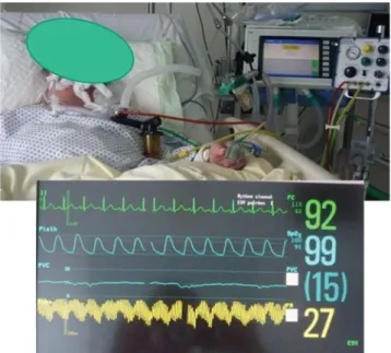 Fig.  2.  Utilisation  invasive  de  la  ventilation  à  percussions  intra- intra-pulmonaires (IPV)