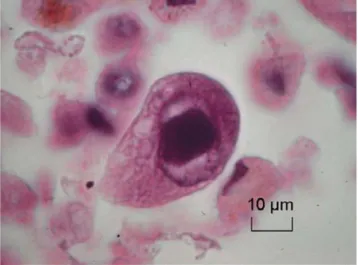 Fig. 2 Effet cytopathogène cytoplasmique spécifique du cyto- cyto-mégalovirus dans une cellule recueillie lors d ’ un lavage  bron-choalvéolaire