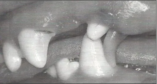 Figure   19     :   persistance   de   la   canine   temporaire   maxillaire   entraînant   un   défaut   d'éruption   et   une  malocclusion de la canine permanente (Hennet, 2006)