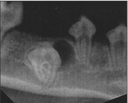 Figure 30 : radiographie dentaire révélant un kyste dentigère sur une PM4 mandibulaire incluse chez un  boxer (Hennet et Boutoille, 2013)