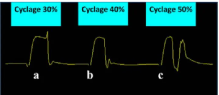 Fig. 3 Courbe de pression en fonction du temps en VS-AI-PEP : effets de la modification de la consigne de cyclage inspiratoire – expiratoire : a : cyclage tardif ; b : cyclage optimal ; c : cyclage prématuré