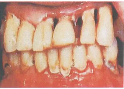 Figure 12 : Carence en ac ides foliqu es. Parodontite chronique avec pelies dentaires (STEGEM AN C.A., DAVIS J.R