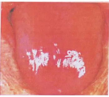 Figure 18 : gloss ite liée à une carence en fer [STEGEMAN c.A., DAVI S .T.R. , 2005]