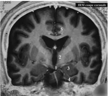 Fig. 1 Le cerveau limbique. 1 : tubercules mamillaires, hypotha- hypotha-lamus ; 2 : thahypotha-lamus ; 3 : amygdale temporale ; 4 : gyrus  parahippo-campique ; 5 : gyrus cingulaire ; 6 : noyaux du septum