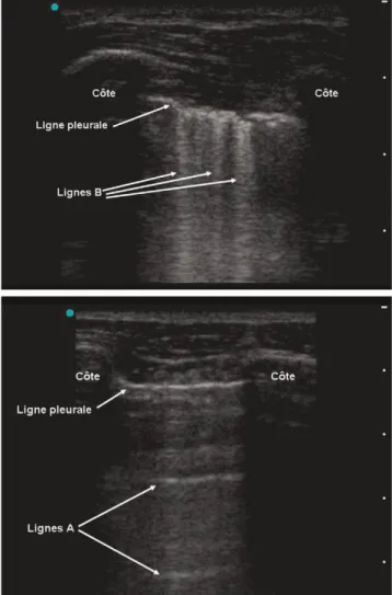 Fig. 3 Étude des lignes A et B. a : présence de lignes B chez un patient atteint de SDRA sans pneumothorax