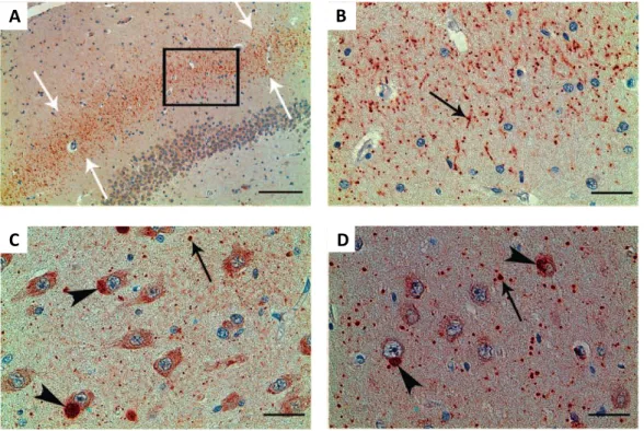Figure 17: Photos représentatives des inclusions positives pour l’ubiquiline 2 observées dans l’hippocampe  d’un patient atteint de SLA liée à l’ubiquiline 2 P506T 