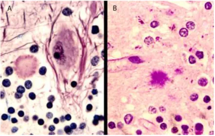 Figure 4 : Plaques multicentriques dans le cervelet d’un patient atteint d’un GSS Immunomarquage de la PrP par l’anticorps 3F4