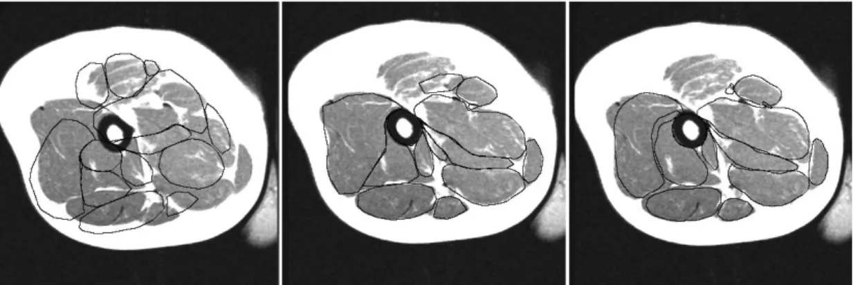 Figure 2 . 1 . 3 – Muscle segmentation using deformable models with a shape matching prior (Gilles and Pai, 2008): from the first iteration (left) to the last (right).