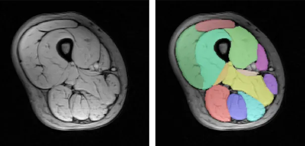 Figure 3.3.2 – (left) Axial cross-section of a right thigh; (right) manual segmentation