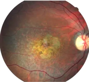 Figure  1.  Photographie  d’une  rétine  atteinte  d’une  dystrophie  maculaire  de  Stargardt  (Centre  d’Investigation  Clinique  du  Centre  Hospitalier  National  d’Ophtalmologie  des  Quinze-Vingts)