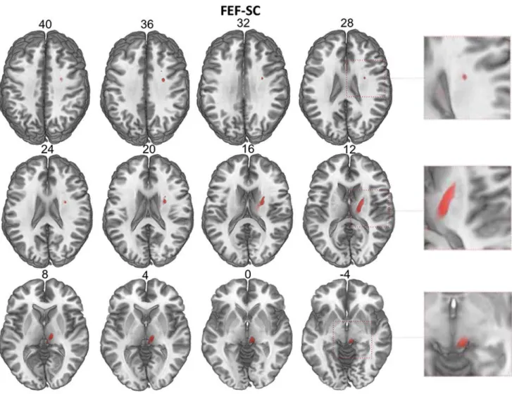 Fig. 5. Mean anatomical trajectory within a brain template of the most probable connection between the FEF and the SC revealed by our study, found correlated with visual sen- sen-sitivity modulations