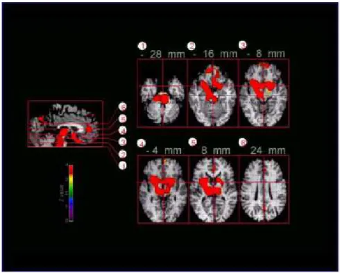 Figure 6. Neuroanatomie fonctionnelle du sommeil lent profond humain, évaluée par  tomographie à émission de positons