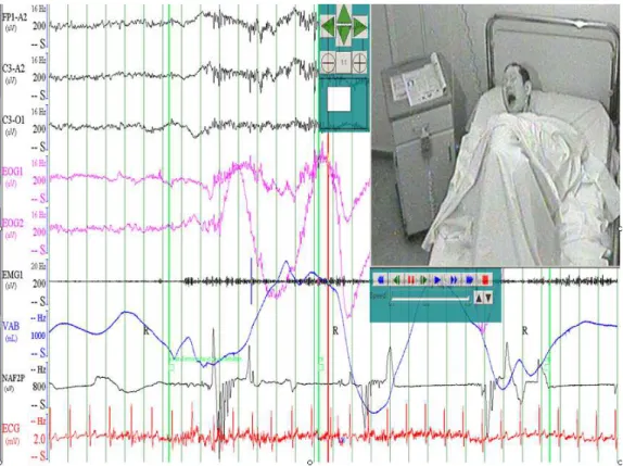 Figure 12. Extrait d’enregistrement polysomnographique et image vidéo associée d’un sujet  atteint de trouble du comportement en sommeil paradoxal.