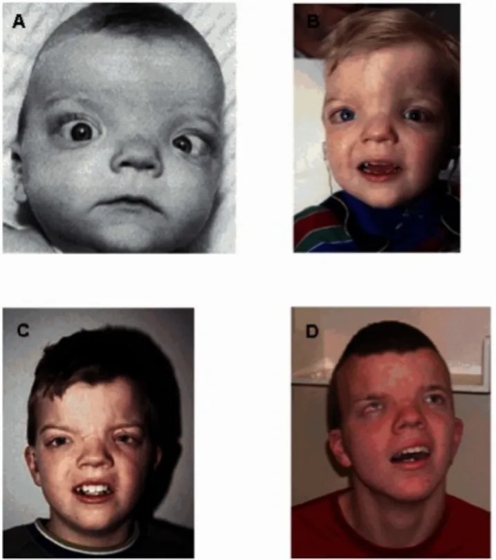 Figure 4 : Le syndrome de Donnai-Barrow.  