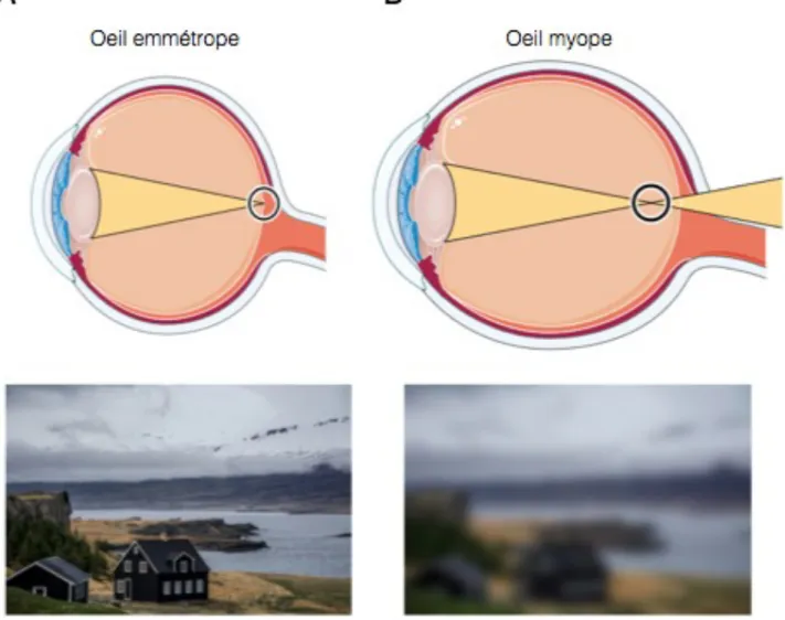 Figure 6 : L’oeil et la vision d’un myope.  