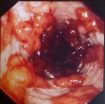 Figure 10: Image d’une coloscopie d’un patient atteint de colite aigüe grave  avec ulcérations étendues et creusantes d’après Zeitoun, Lefevre, 