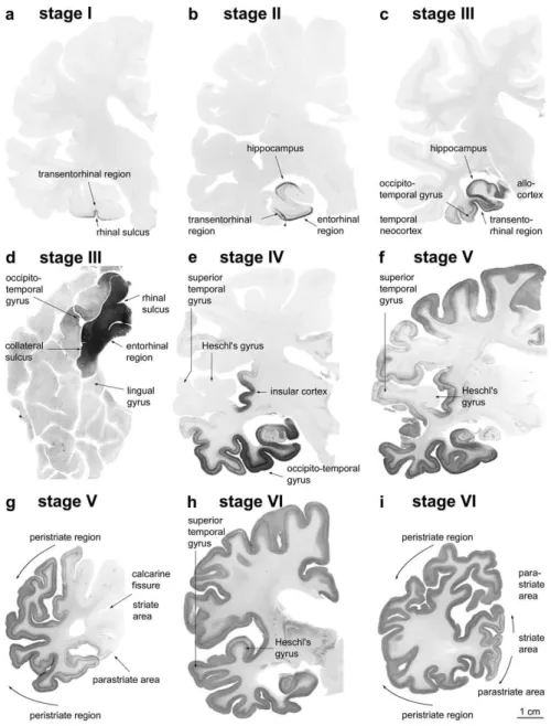 Figure 9 : Les six stades  de la dégénérescence neurofibrillaire sur des sections d’hémisphères révélées par  un immuno marquage dirigé contre la proteine Tau Hyperphosphorylée (AT8 immunoreactivité)