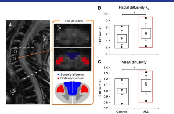 Figure 2 shows the mean PT and MT for median and ulnar nerves in controls and patients