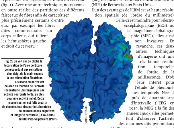 fig. 2 : On voit sur ce cliché la  localisation de l’aire corticale  correspondant aux sensations  d’un doigt de la main soumis   à une stimulation électrique