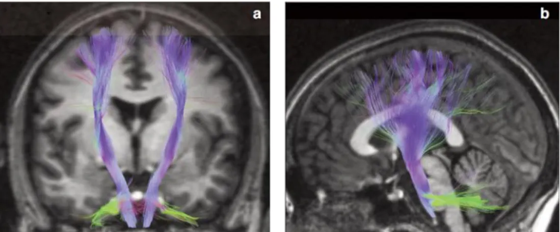 Figure  3:  Partie  cérébrale  de  l’axe  corticospinal  humain,  visualisé  par    Imagerie  à  Résonance  Magnétique en tenseur de diffusion, suivant une coupe coronale (Gauche) ou sagittale (Droite)
