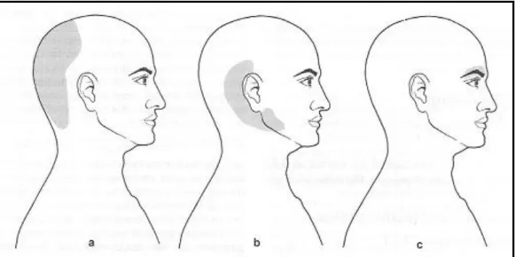Figure 4 : Les trois types de céphalée cervicale, d'après R. Maigne (a = occipitale, b = occipito-temporo-maxillaire, c = sus- sus-orbitaire) 