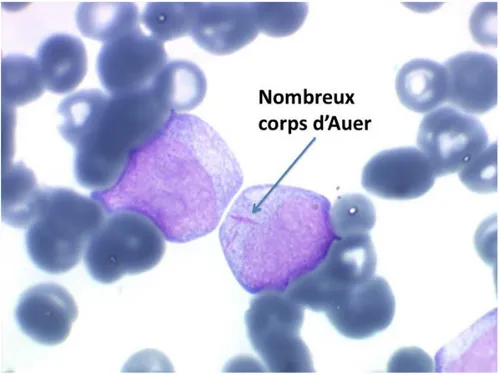 Figure 4 : corps d’Auer exprimant le caractère myéloïde d’une leucémie. Disponible  sur http://cytologie-sanguine.com/index.php 