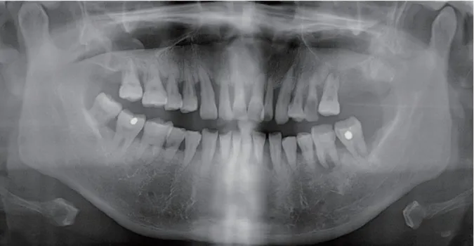Figure 6 : radiographie panoramique d’une patiente leucémique évocatrice d’une  parodontite chronique généralisée avec une importante perte d’os et de nombreux 