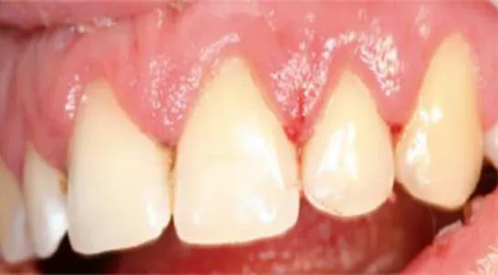 Figure 10 : vue endobuccale palatine d’une GUN chez un patient leucémique avec la  présence d’ulcérations nécrotiques recouvertes d’un enduit fibrinoleucocytaire 